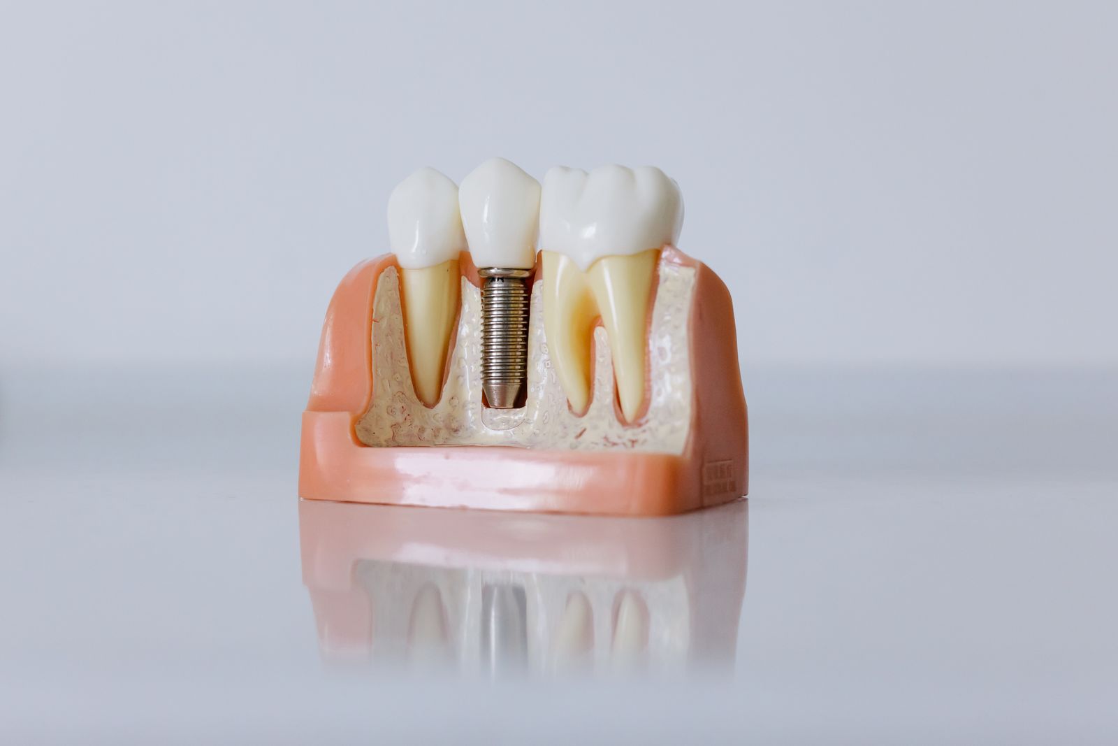 Dental implant procedure